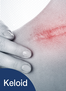 รักษาKeloid