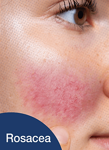 โรซาเชีย Rosacea