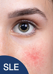 รักษาSLE