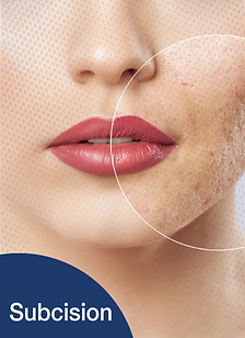 รักษาSUBCISION