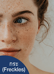 รักษากระ