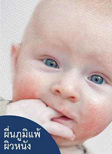 รักษาผื่นแพ้สัมผัส