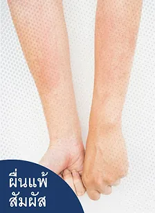 รักษาผื่นแพ้สัมผัส