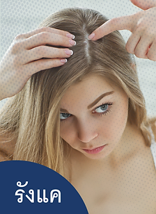 รักษารังแค