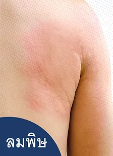 รักษาลมพิษ