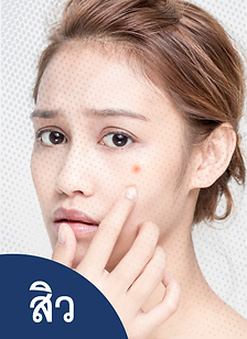 รักษาสิว กำจัดสิวเสี้ยน