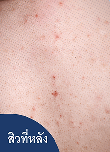 รักษาสิวที่หลัง