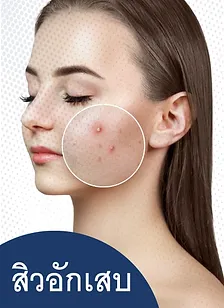 สิวอักเสบ วิธีการป้องกันและรักษาสิวสิวอักเสบ