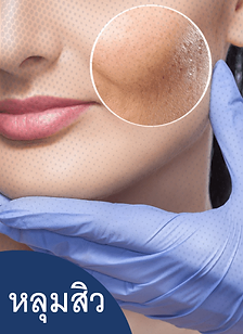 หลุมสิว วิธีการรักษาหลุมสิว