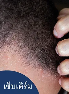 รักษาโรคเซ็บเดิร์ม